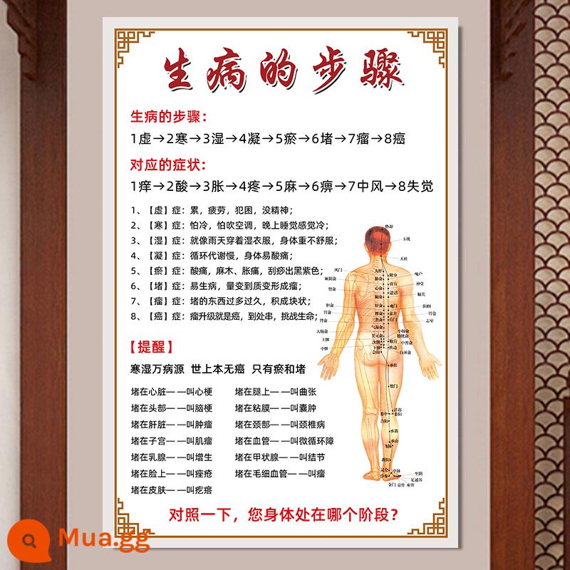 Moxibustion, xoa bóp, giác hơi, cạo, xoa bóp, áp phích vật lý trị liệu, bản đồ công khai cửa hàng xoa bóp, trung tâm y tế y học cổ truyền Trung Quốc, tranh treo trang trí - 33- Các bước phát bệnh