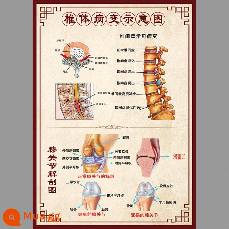 Hình ảnh cột sống cổ vai viêm quanh khớp poster thoái hóa đốt sống cổ cột sống thắt lưng bản đồ tăng sản xương sticker dán tường gói phong phú poster tuyên truyền - Sơ đồ tổn thương thân đốt sống 626