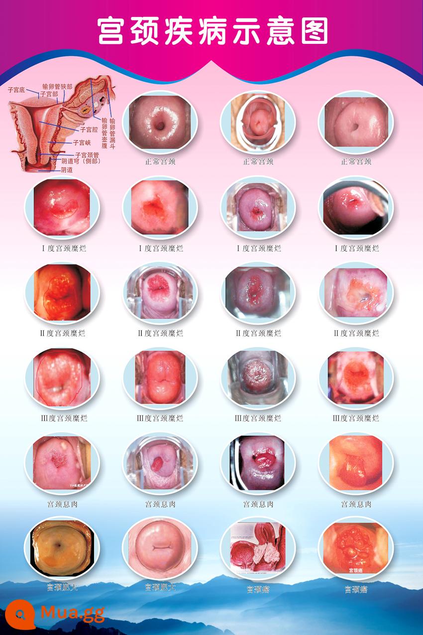 Sơ đồ giải phẫu hệ thống sinh dục nữ sơ đồ bệnh viện áp phích treo tường tử cung áp phích phụ khoa sơ đồ bệnh cổ tử cung - Sơ đồ cổ tử cung-3