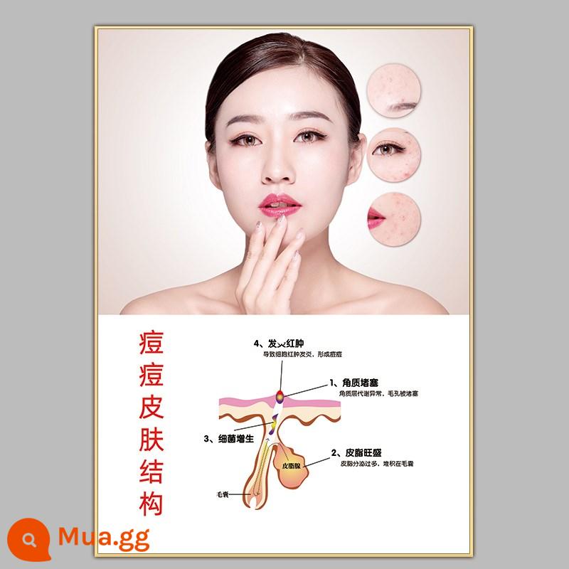 Hình ảnh in poster xóa tàn nhang trị mụn - 14 Cấu trúc da mụn