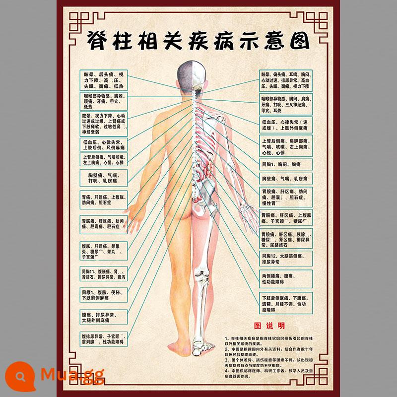 Hình ảnh cột sống cổ vai viêm quanh khớp poster thoái hóa đốt sống cổ cột sống thắt lưng bản đồ tăng sản xương sticker dán tường gói phong phú poster tuyên truyền - Sơ đồ các bệnh liên quan đến cột sống 626