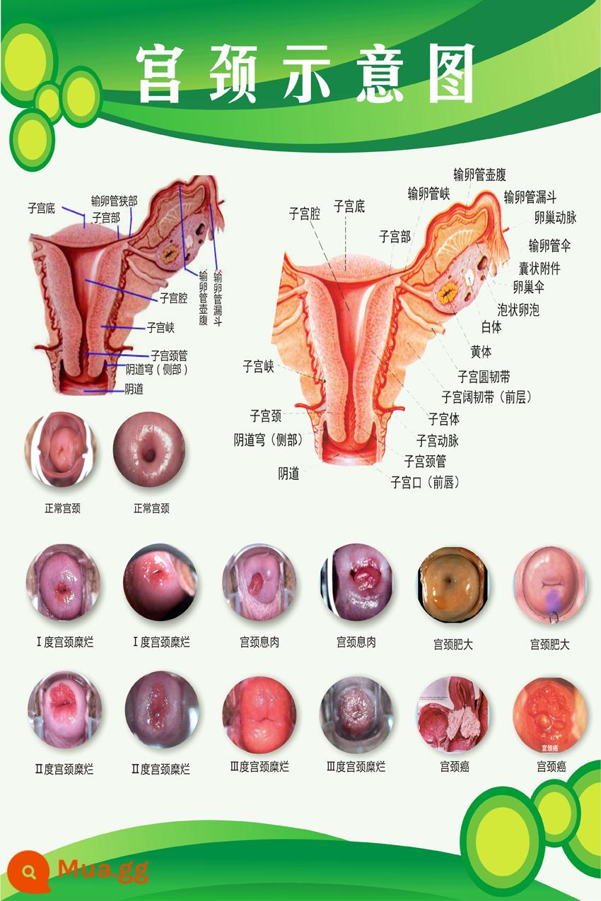 Sơ đồ giải phẫu hệ thống sinh dục nữ sơ đồ bệnh viện áp phích treo tường tử cung áp phích phụ khoa sơ đồ bệnh cổ tử cung - Sơ đồ cổ tử cung-1