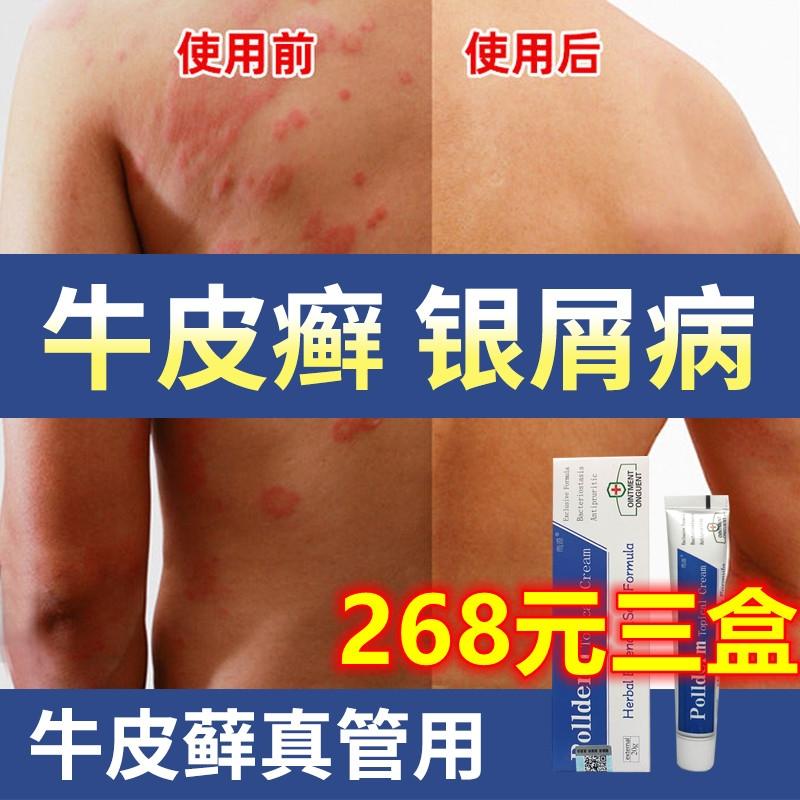 [268 nhân dân tệ, ba hộp, nguyên liệu nhập khẩu, không chứa hormone] Thuốc mỡ kết hợp bệnh vẩy nến và bệnh vẩy nến