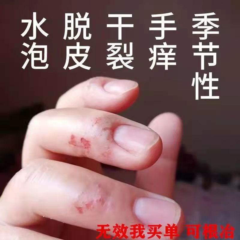 Côn trùng độc bảy cỏ mồ hôi herpes tay ngứa mụn nước nhỏ tay ngứa bong tróc khô nứt thuốc mỡ ngứa nhiễm nấm thuốc mỡ đặc trị chống ngứa