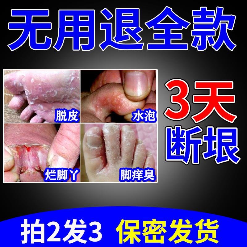 Thuốc Athlete's foot trị ngứa chân, giảm ngứa, loại bỏ tận gốc tạo tác, bong tróc, sát trùng, nhiễm nấm, mụn nước, thối chân, kháng khuẩn