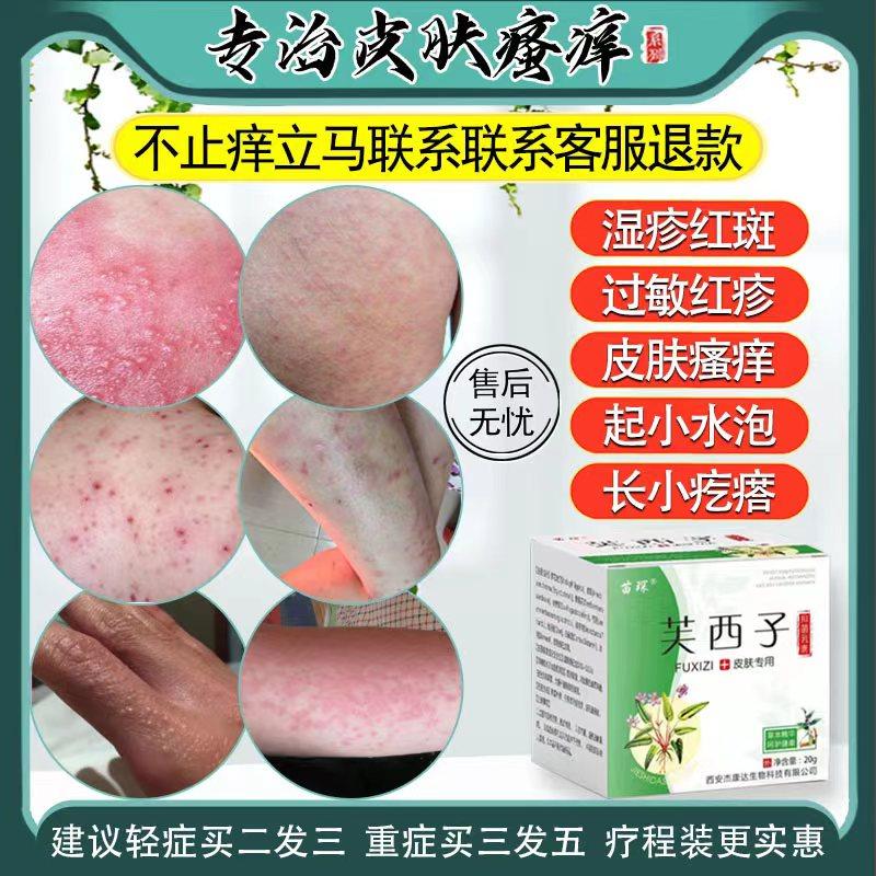 Eczema tận gốc da ngứa sưng đỏ ban đỏ dài tay ngứa mụn nước nhỏ viêm da phát ban dị ứng phát ban thuốc mỡ chống ngứa