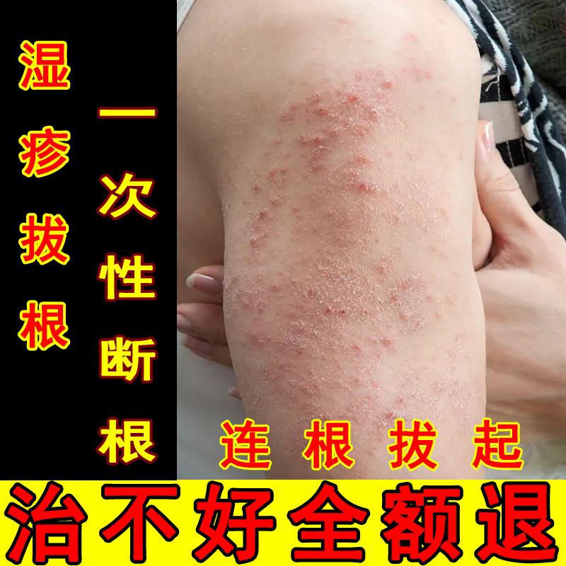 Eczema Antipruritic khử trùng mãn tính Viêm thuốc mỡ thực vật Thảo dược Eczema thuốc mỡ người lớn ngứa kem vi khuẩn ở người lớn