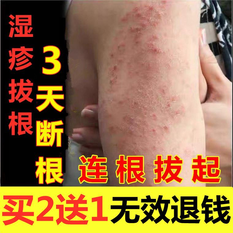 Eczema Antipruritic khử trùng mãn tính Viêm thuốc mỡ thực vật Thảo dược Eczema thuốc mỡ người lớn ngứa kem vi khuẩn ở người lớn