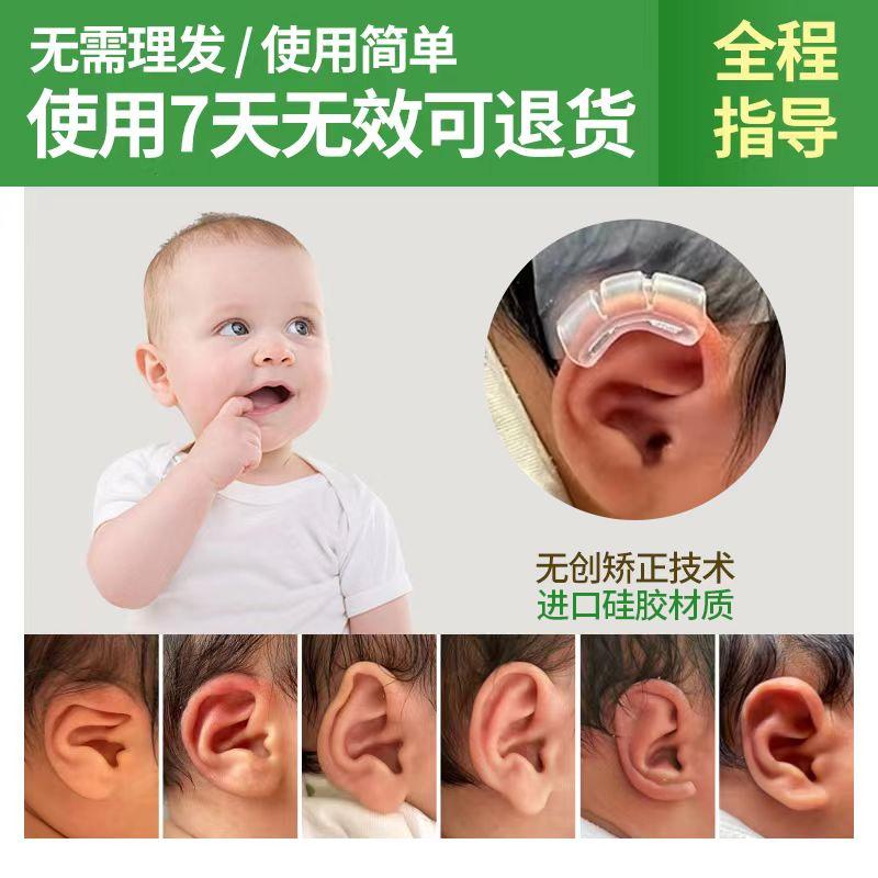 Bé auricle Corrector tai bé định hình miếng dán thùy tai kẹp định hình sơ sinh băng silicon tai biến dạng